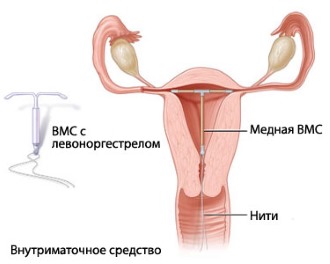 Внутриматочная спираль