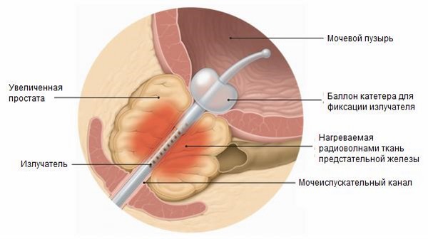 Баллонная дилатация уретры